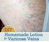 Photos of Early Varicose Veins Treatment