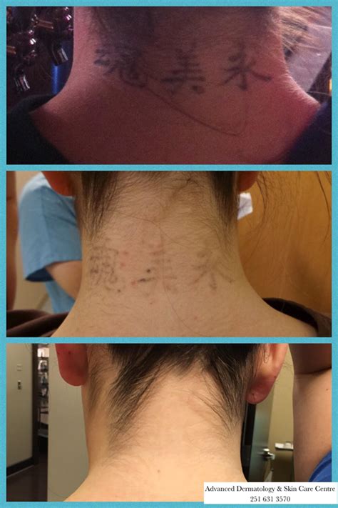 Picosure Tattoo Removal Advanced Dermatology And Skin Care Centre
