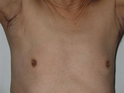 External Photography Of Patients Chest Showing Enlarged Lymph Node In