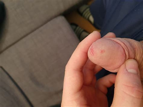 Red Bump On Glans And Rashes On Shaft Penis Disorders Forums Patient