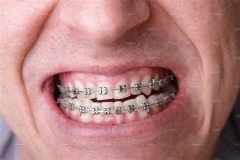 Metal orthodontic braces on crooked featuring braces, brackets, and ...