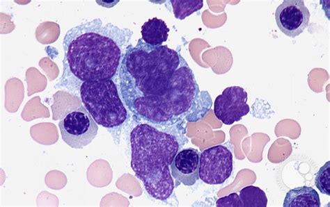 Diffuse Large B Cell Lymphoma Bone Marrow Aspirate 2