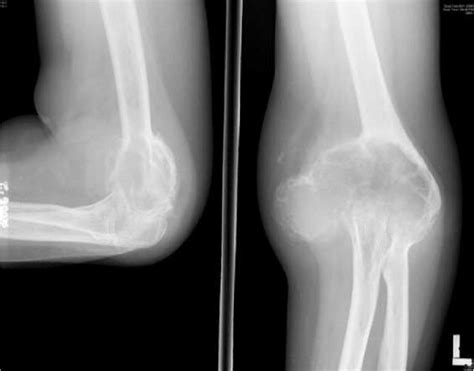 Full Text Giant Cell Tumour Of The Distal Humerus Treated With Elbow Arthroplasty A Case