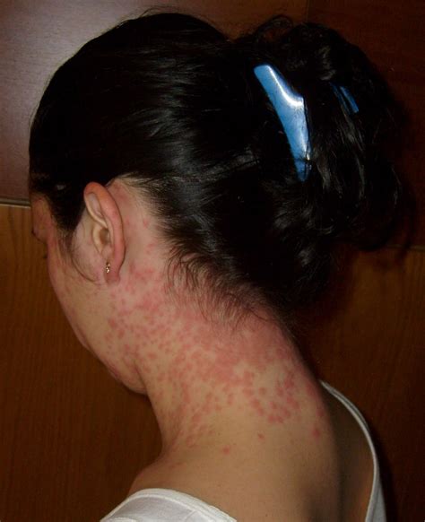 Fileeuproctis Chrysorrhoea Skin Rash Wikipedia