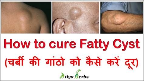 How To Cure Fatty Cyst Hakeem Suleman Khan