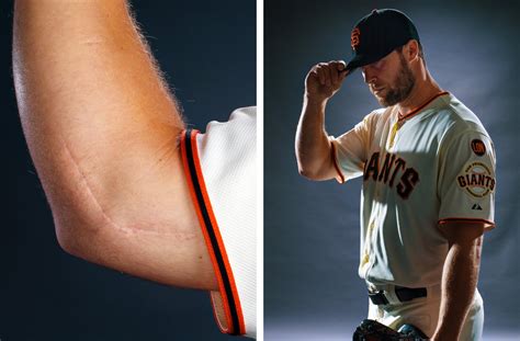 With Tommy John Surgery Every Scar Tells A Story The New York Times