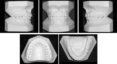 Figure From Correction Of Bilateral Impacted Mandibular Canines With