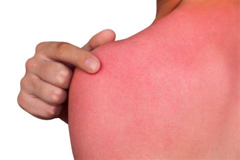 Chlorine Rash How Long Does It Last And How To Treat It