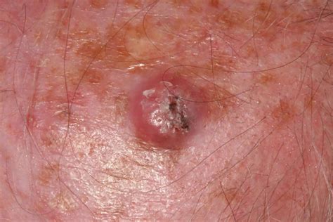 Tonsil cancer symptoms, pictures, treatment tonsil cancer is a type of cancer that occurs in one of the three types of tonsils of the throat. How to Visually Identify the Various Forms of Skin Cancer ...