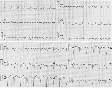 Figure 1 From St Elevation Myocardial Infarction Associated With Acute