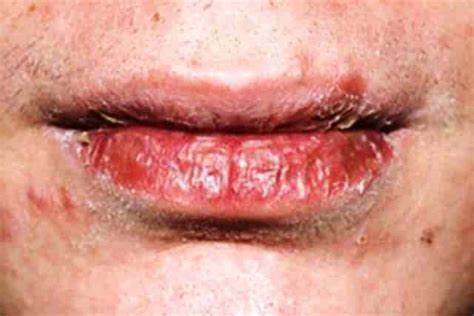 Dry Patches On Lip Upper Lower Pictures Causes Not Cold Sore