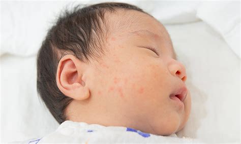 Reasons For Rashes On Infant Skins And How To Treat Them 41 Off