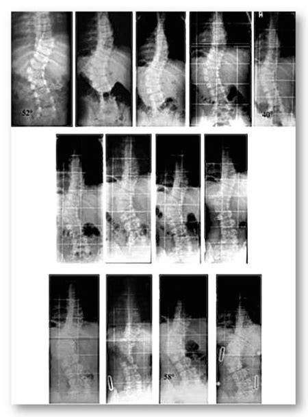 Conservative Treatment Of Congenital Scoliosis Case Report With A