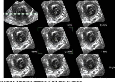 Figure 1 From Ultrasound Assessment Of The Uterine Wall After