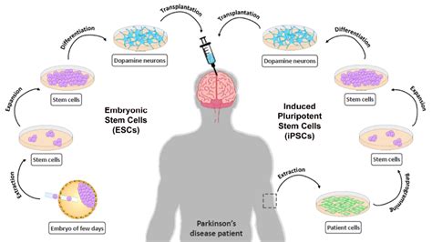 Stem Cell Therapy For Parkinsons Disease Atlas Of Science