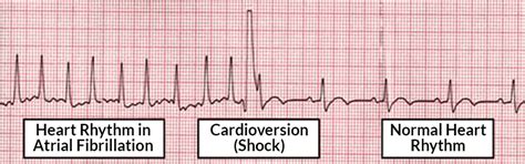 Becoming Familiar With Synchronized Cardioversion