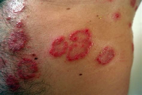 Psoriasis What Is It Pictures Causes Symptoms Treatment I Need