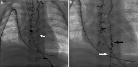Vascular Interventions Lymphangiography And Thoracic Duct Embolization
