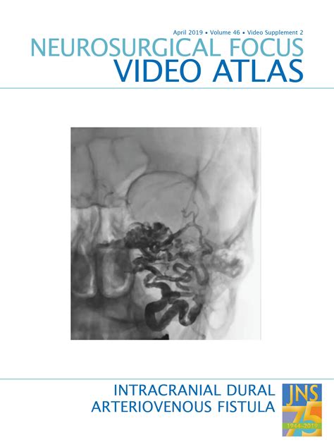 Right Jugular Foramen Dural Arteriovenous Fistula Cognard Iv In