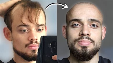 100 Balding Men Beforeafter Shaving Head Bald 2 Youtube