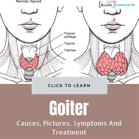 Goiter Causes Pictures Symptoms And Treatment