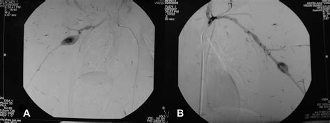 Bilateral Axillary Artery Aneurysms In A Six Year Old Child Annals Of