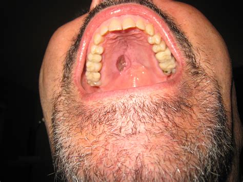Different types of sores or these bumps will appear on the inner surface of your lips and don't usually affect the roof or floor of if large white patches form on your tongue as well as the roof of your mouth because this could be. Sinusitis Roof Of Mouth