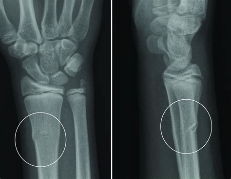 Buckle Fracture Raleigh Hand Surgery Joseph J Schreiber Md