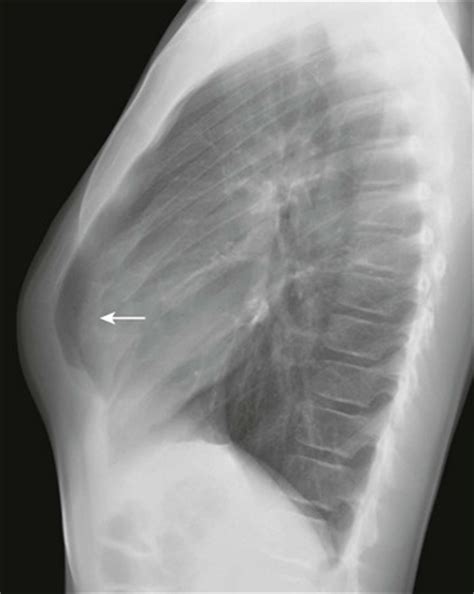 The pectus excavatum had nothing to do with his death. The Chest Wall | Radiology Key