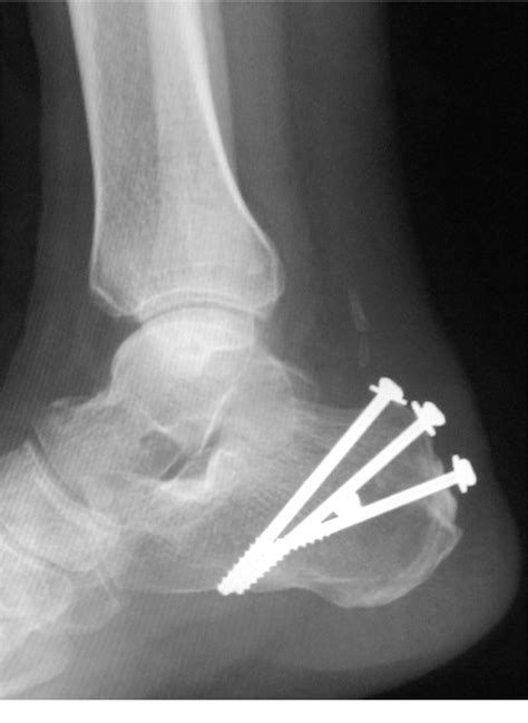Figure 4 From Calcaneal Tuberosity Avulsion Fracture An Unusual