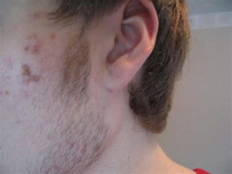 Scar Logs Scars And Dead Skin Zit Face Image 5 Pictures And Videos