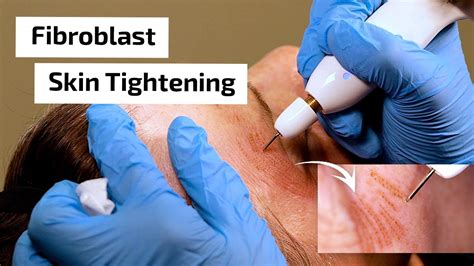 What Is Fibroblast Skin Tightening Prime Plasma Youtube
