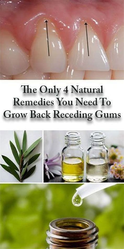 The Only 4 Natural Remedies You Need To Grow Back Receding Gums