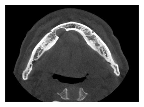 Cone Beam Computed Tomography Cbct A Axial Image Two Defects Of