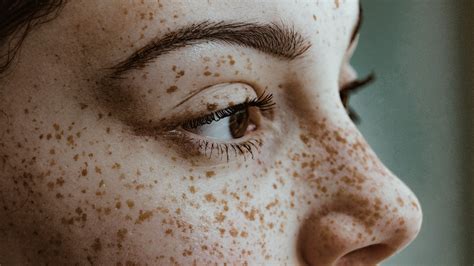 the fascinating science behind what causes freckles