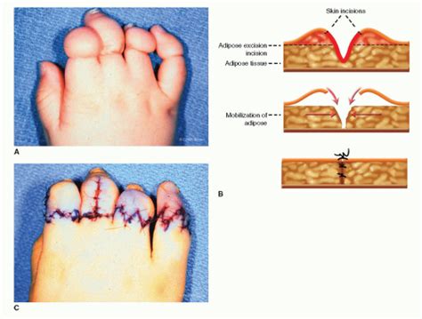 Amniotic Band Syndrome Toes