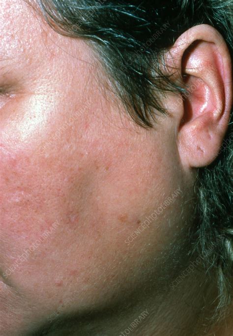 Parotid Swelling Due To Blocked Salivary Duct Stock Image M2400227