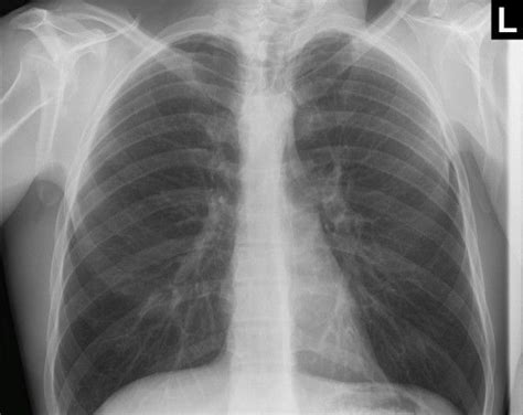 Usually all radiographic abnormalities should disappear after 6 weeks of appropriate. Normal Chest X-ray Module: Train Your Eye - ChestX-ray.com ...