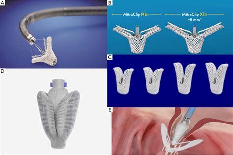 Transcatheter Mitral Valve Repair