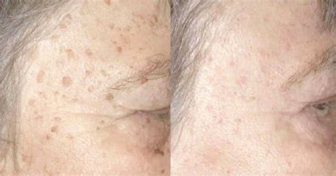 5 Remedies For Quickly Removing Age Spots Without Damaging Your Skin