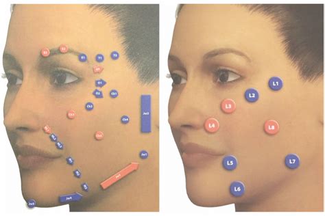 Top Model Look Com Preenchimento Na Harmonização Orofacial