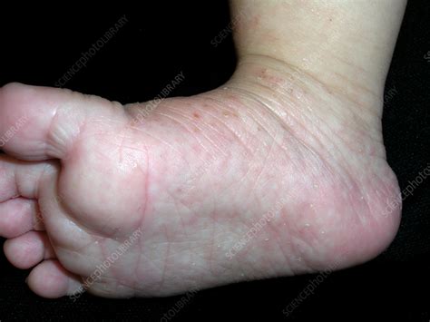 Acropustulosis Of Infancy Stock Image C0567895 Science Photo Library