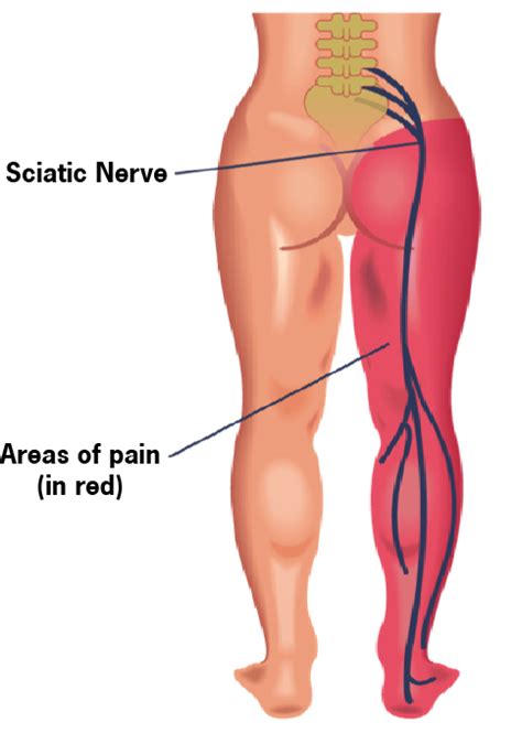 Sciatic nerve pain, commonly known as sciatica, refers to pain that radiates along the sciatic nerve branching from the lower back down the hips and buttocks. How to treat Sciatica or Sciatic Nerve Pain