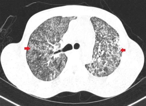 Cureus Miliary Tuberculosis With Acute Respiratory Distress Syndrome