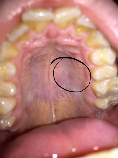 bump on roof of mouth pic repost r dentistry