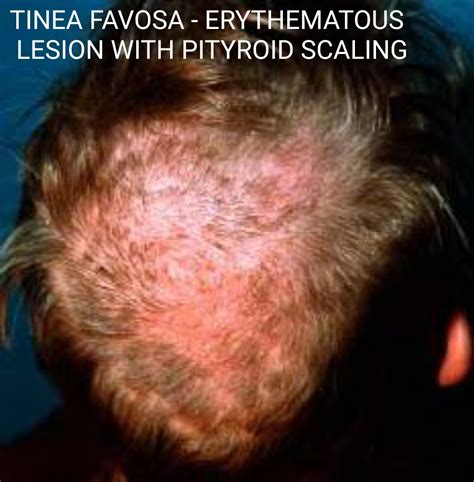 Tinea Favosa Erythematous Lesion With Pityroid Scaling Neet Pg