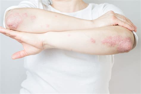 Plaque Psoriasis Causes Triggers Symptoms And Treatments
