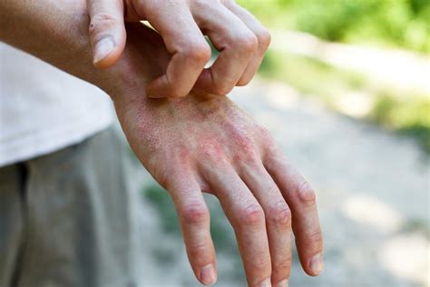 Todo Lo Que Debes Saber Sobre La Dermatitis At Pica O Eczema El Nuevo D A