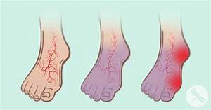 Varicose Veins, How to Reduce Them Naturally - Healthy Holistic Living  Heart and Circulation Varicose Veins