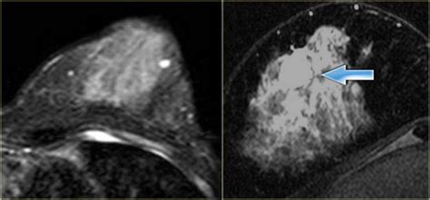 The Radiology Assistant Mri Of The Breast